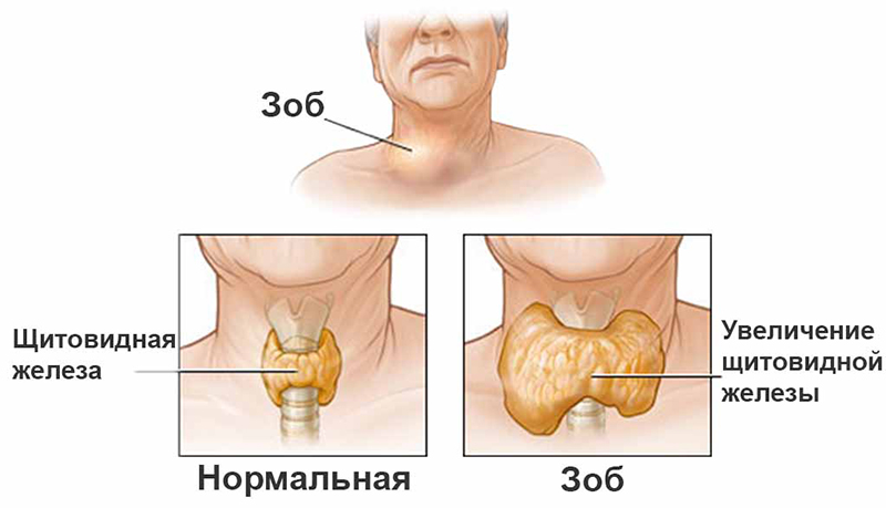 УЗИ щитовидной железы 