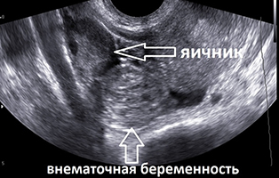 УЗИ - внематочная беременность