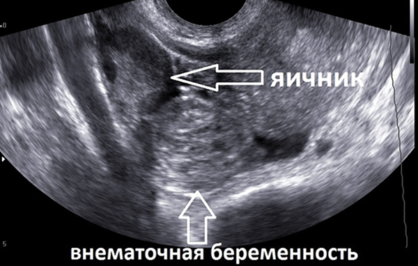 Трансвагинальное УЗИ  при внематочной беременности