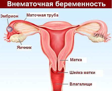 Локализация внематочной беременности 