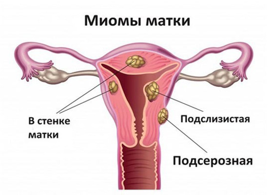 Схема миома матки 