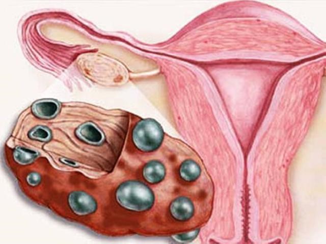 Поликистоз яичников у женщин